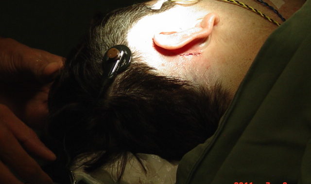 Imagem da cirurgia. Aparece apenas a cabeça do David, com o cabelo raspado ao redor da orelha. No momento da foto, ele estava com a parte externa do Implante Coclear conectada à cabeça, a fim de testar os eletrodos.